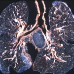 complicated black lung disease