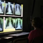 xrays of black lung sufferers, Photo by CDC-NIOSH