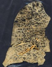 Photo shows a lung covered in black splotches from black lung disease.